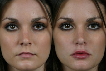 Juvederm Ultra Plus before 296319