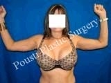 Arm Lift 644534