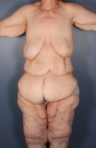 Posterior Body Lift, Medial Thigh Lift, Pannicuctomy before 456144