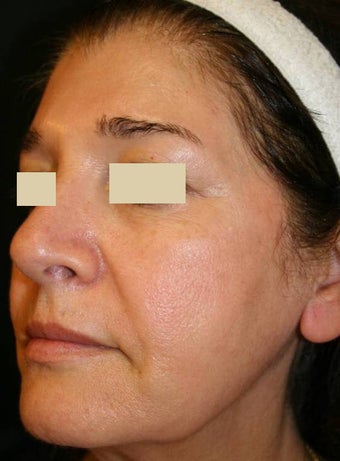 Sculptra Liquid Lift before 137158