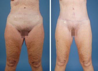 Flank Excision, Abdominoplasty Scar Revision, Liposuction of the Back before 303691