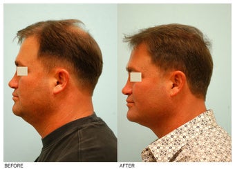Crown (Vertex) Hair Transplant before 134770