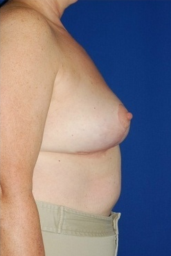 Heavy breast treatment, implant removal and breast lift after 158172