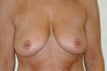 Full Mastopexy Breast Augmentation before 244755