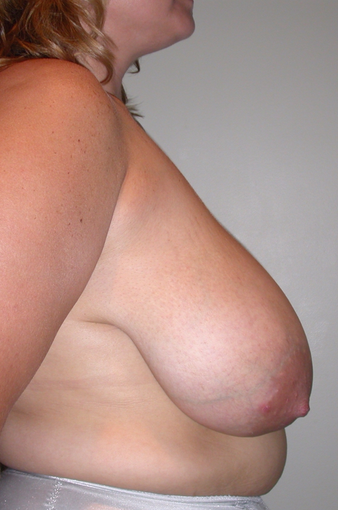 Breast reduction via a short scar technique before 275511