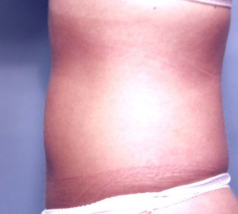 Slim Lipo after 137508