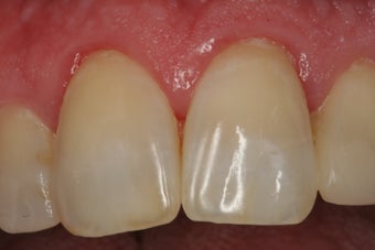 Internal Bleaching of Non-Vital Tooth after 379270