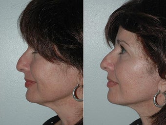 Facelift after 472172