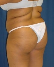 Brazilian Butt Lift before 101296