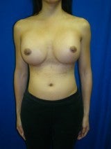 Revision Breast Surgery after 356593