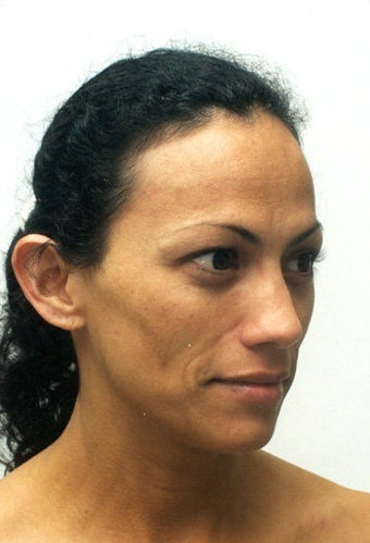 endoscopic brow-lift, upper and lower lid blepharoplasty, septorhinoplasty and lipo transfer to the midface area before 301282
