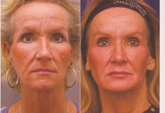 Sculptra before 331566