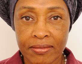 Lower Blepharoplasty (Lower Eyelids) after 376873