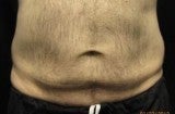 CoolSculpting before 559918