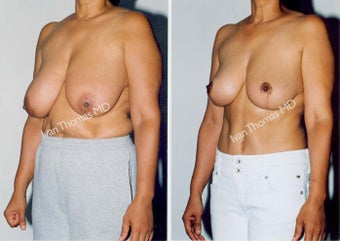 Tummy Tuck and Breast Reduction before 247328