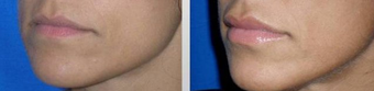 Lip Augmentation before 167641