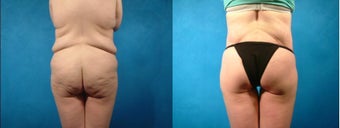 Lower Body Lift before 134123