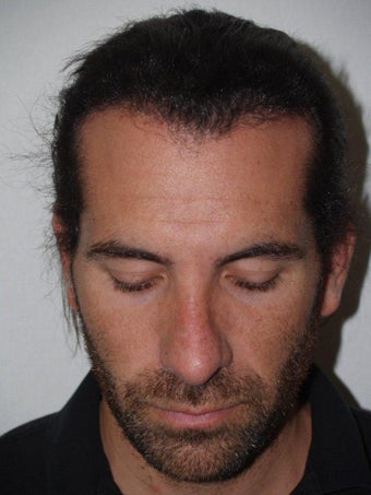 Hair Transplant and Rhinoplasty after 218207