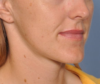 Chin Reduction before 521959