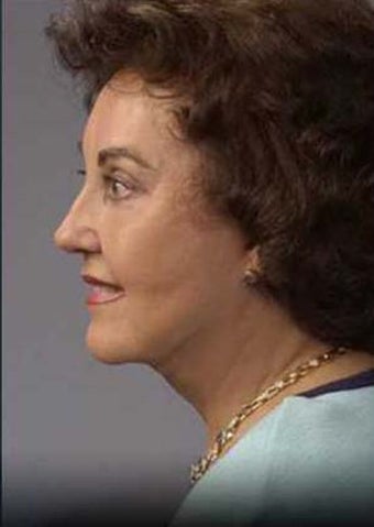 Refresher Facelift w/Neck Plication, Browllift, Upper & Lower Lids, Fat Injections to Cheeks & Lips after 252881