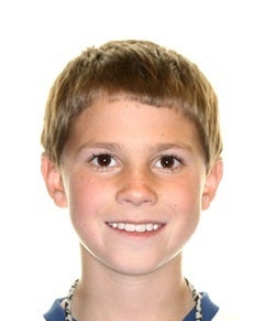 Early Orthodontic Treatment after 344757