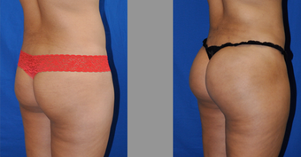 Brazilian Butt Lift before 256050