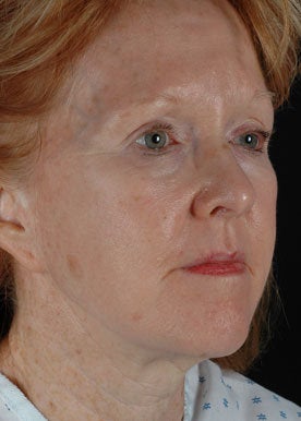 CO2 Laser Resurfacing before 368979