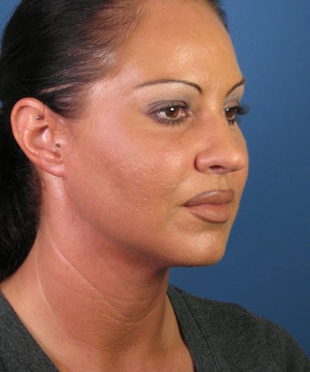 Liposuction after 446439