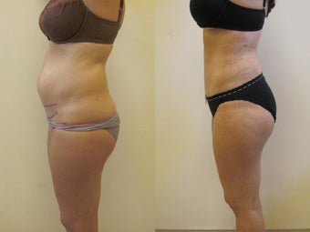 Tummy tuck after 222614
