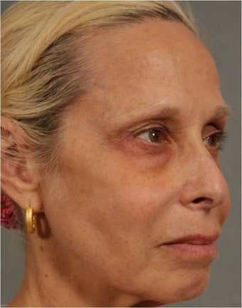 60 Year Old Female treated for under eye puffiness, sagging cheeks and frown lines non surgically 640083