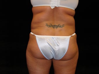 Liposuction of Abdomen, Waist, Flanks, and Inner/Outer Thighs before 203478