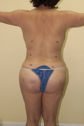 Brazilian butt lift 360617