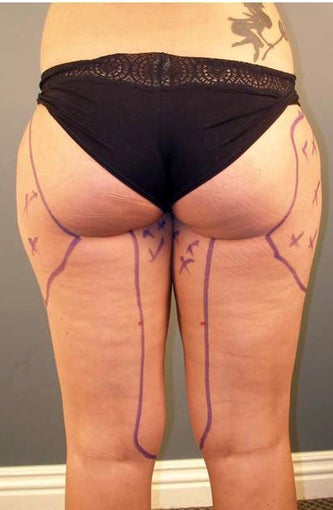 Tumescent Liposuction Under Local Anesthesia. before 331479