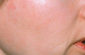 Chemical peel after 374258