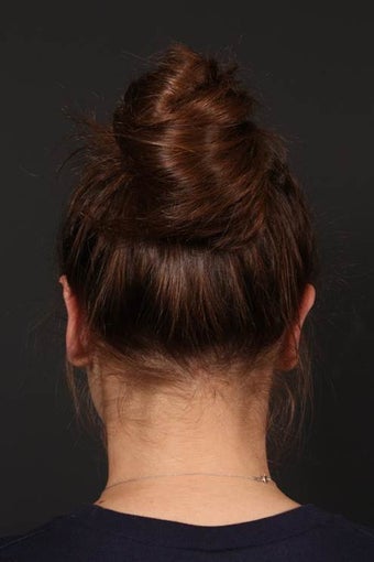 Ear Shaping after 598103