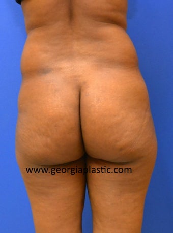 Brazilian Buttock Lift before 440724