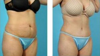 Tummy Tuck (Abdominoplasty) after 324843