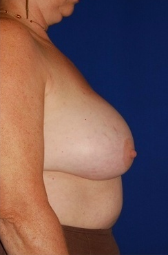 Heavy breast treatment, implant removal and breast lift before 158172