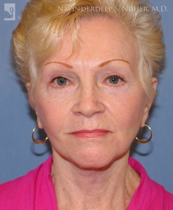 Facelift, Eyelid Surgery & Chin Implant after 501561