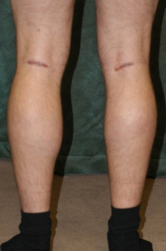Men's Calf Augmentation after 519062