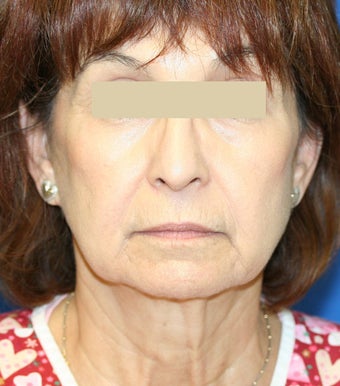 Facelift Gallery before 137142