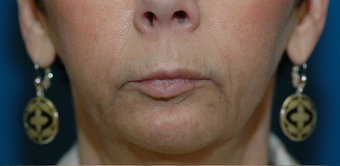 Lip lift + Chin implant + ArteFill before 522080