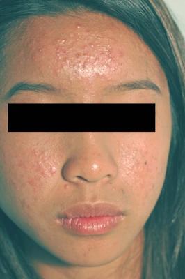 Laser Acne Treatment before 82970