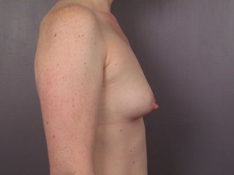 Breast Lift / Breast Augmentation before 291068