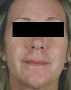 Pulsed Dye Laser Treatments for Rosacea after 104196