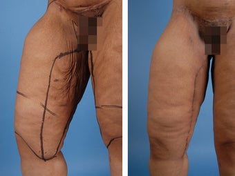 Thighplasty 303693