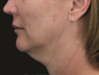 Neck Lift and Laser-Assised Lipocontouring before 406733