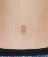 Belly Buttons after Tummy Tuck Surgery after 133867