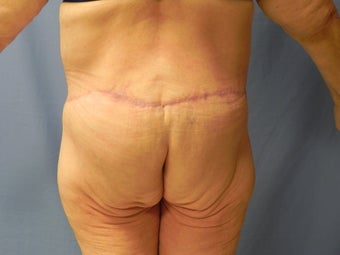 Circumferential Body Lift 364633