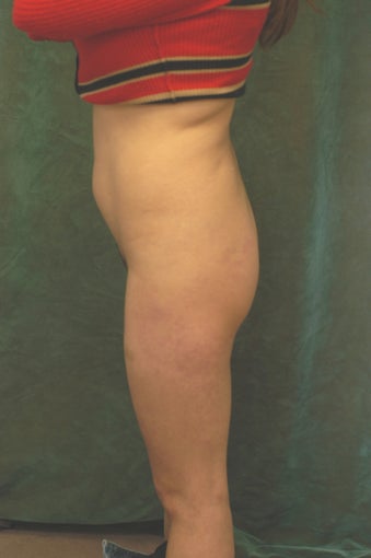 Women's Buttocks Augmentation before 518112